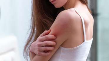 Eczema, Psoriasis & Rosacea